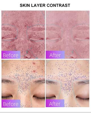 Mua Blue Light Acne Treatment Mask with Intelligent Timer – Manufacturer Direct Supply, Appearance Patent Included sản xuất trực tuyến